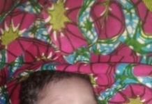 Humanitaire: Un enfant né avec le « bec de lièvre » à Léro