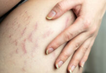 Vergetures : Quand la peau raconte…